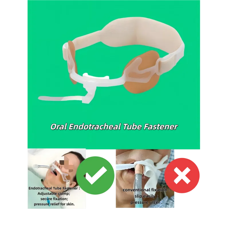Pengikat Tiub Endotrakeal